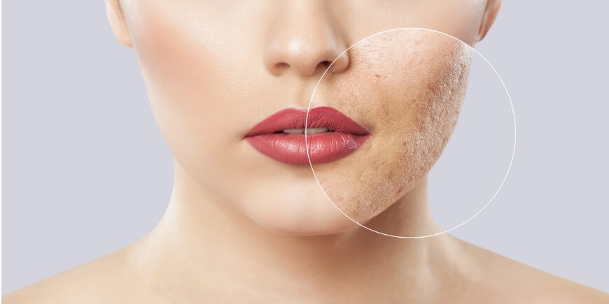 Chronic Skin Conditions