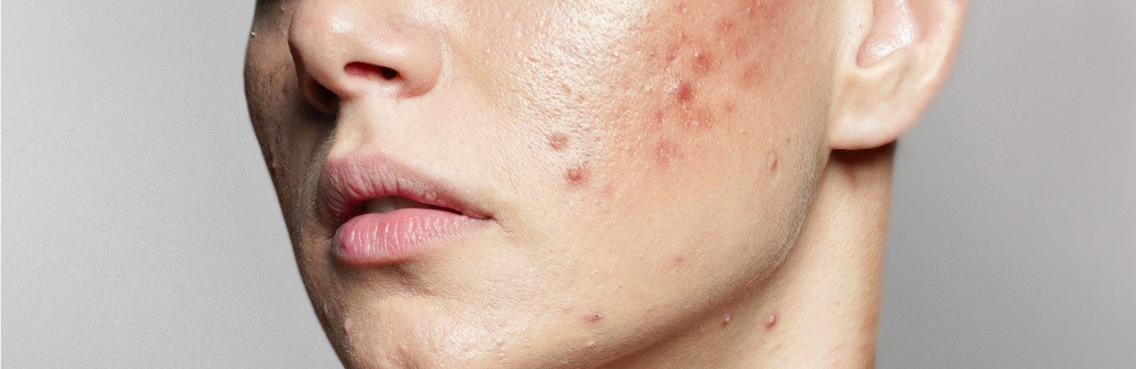 Pustular Acne 