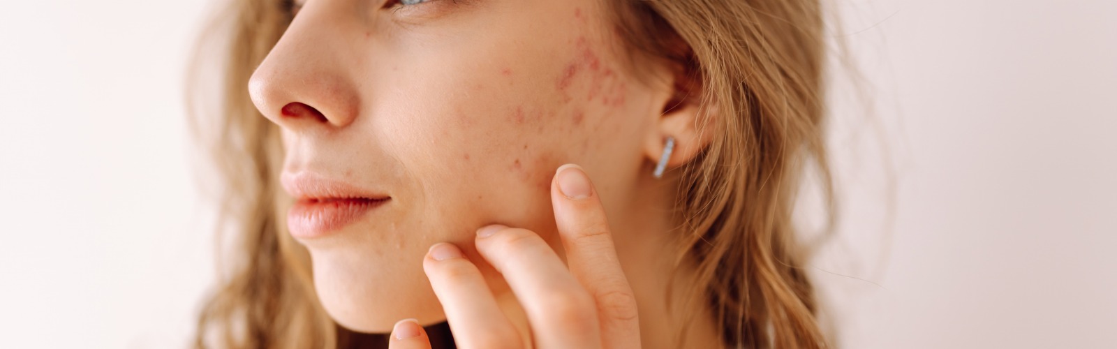 Erythematotelangiectatic Rosacea