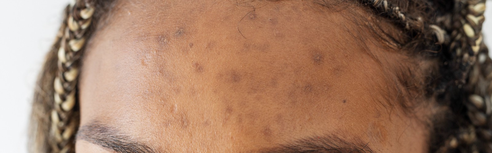 Mongolian Spots