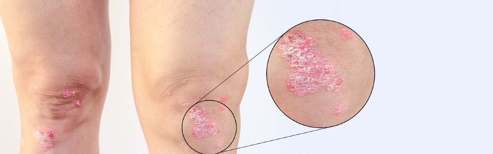Psoriatic Arthritis