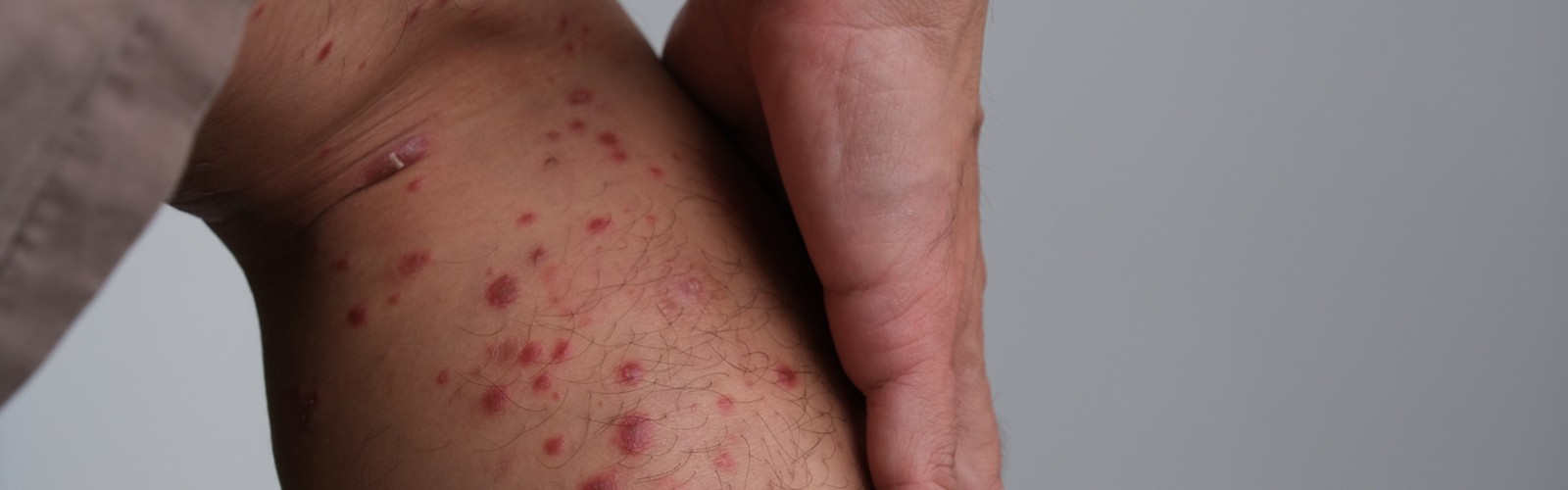 Guttate Psoriasis