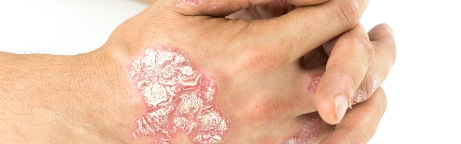 Pustular Psoriasis