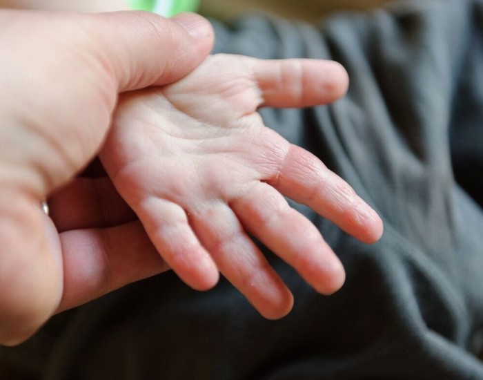 Eczema Symptoms